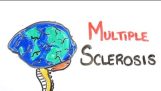 Sclerosi multipla