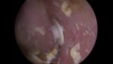 22 слухови филтри отстранени от ухото на пациента