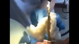 Læge trækker en slange ud af patientens mund