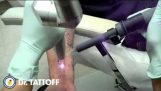 Laser Tattooentfernung
