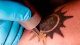 ¿Cómo láser tatuaje obras de eliminación