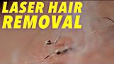 המדע של הסרת שיער בלייזר בהילוך איטי