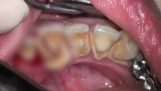 Pulizia dei denti con grande problema di pietra