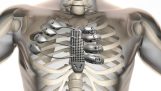3D bedruckten Seite für einen Krebspatienten