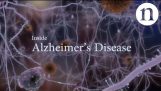 Вътре болестта на Алцхаймер